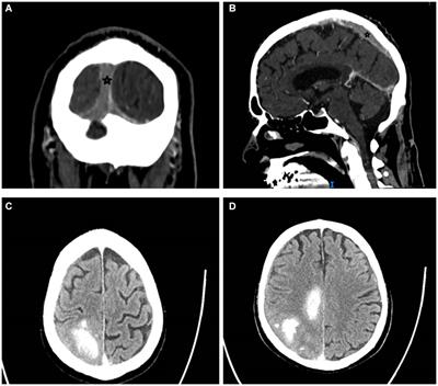 Case report: Cerebral sinus vein thrombosis in VEXAS syndrome